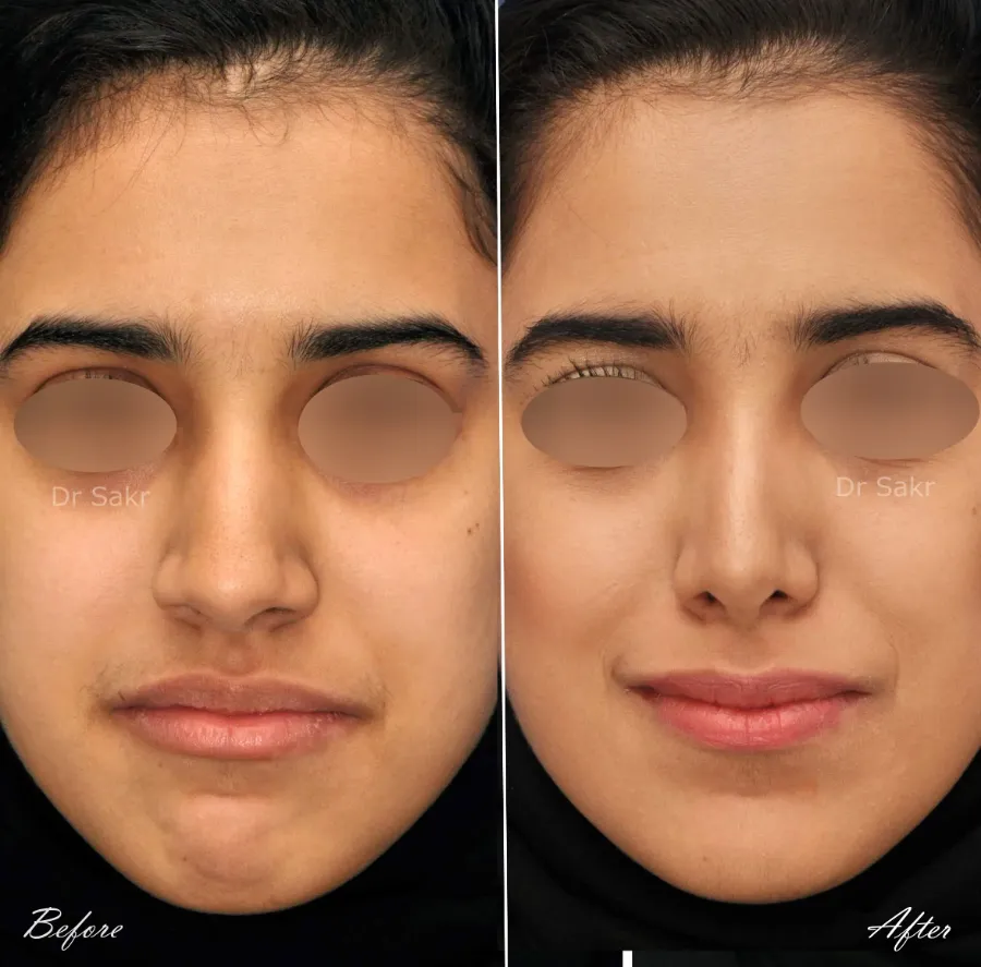 Original before and after nasal surgery photographs from Dr. Habouch's Refinement gallery